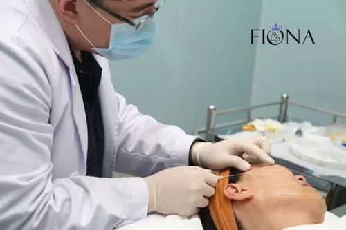 비수술 안면 리프팅 PDO PCL PLACL Cog Thread 안면 리프팅 360 4D 6D 12D W 캐뉼러